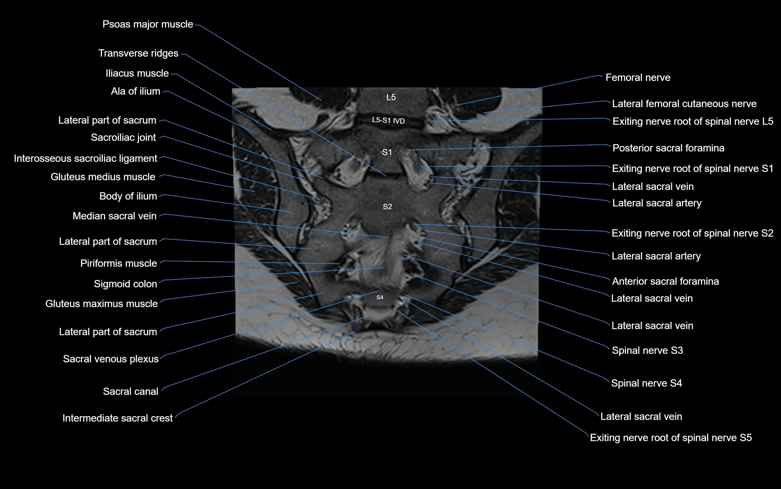 MRI sacroiliac joint coronal cross sectional anatomy  radiology  image-img-00001-00020.webp